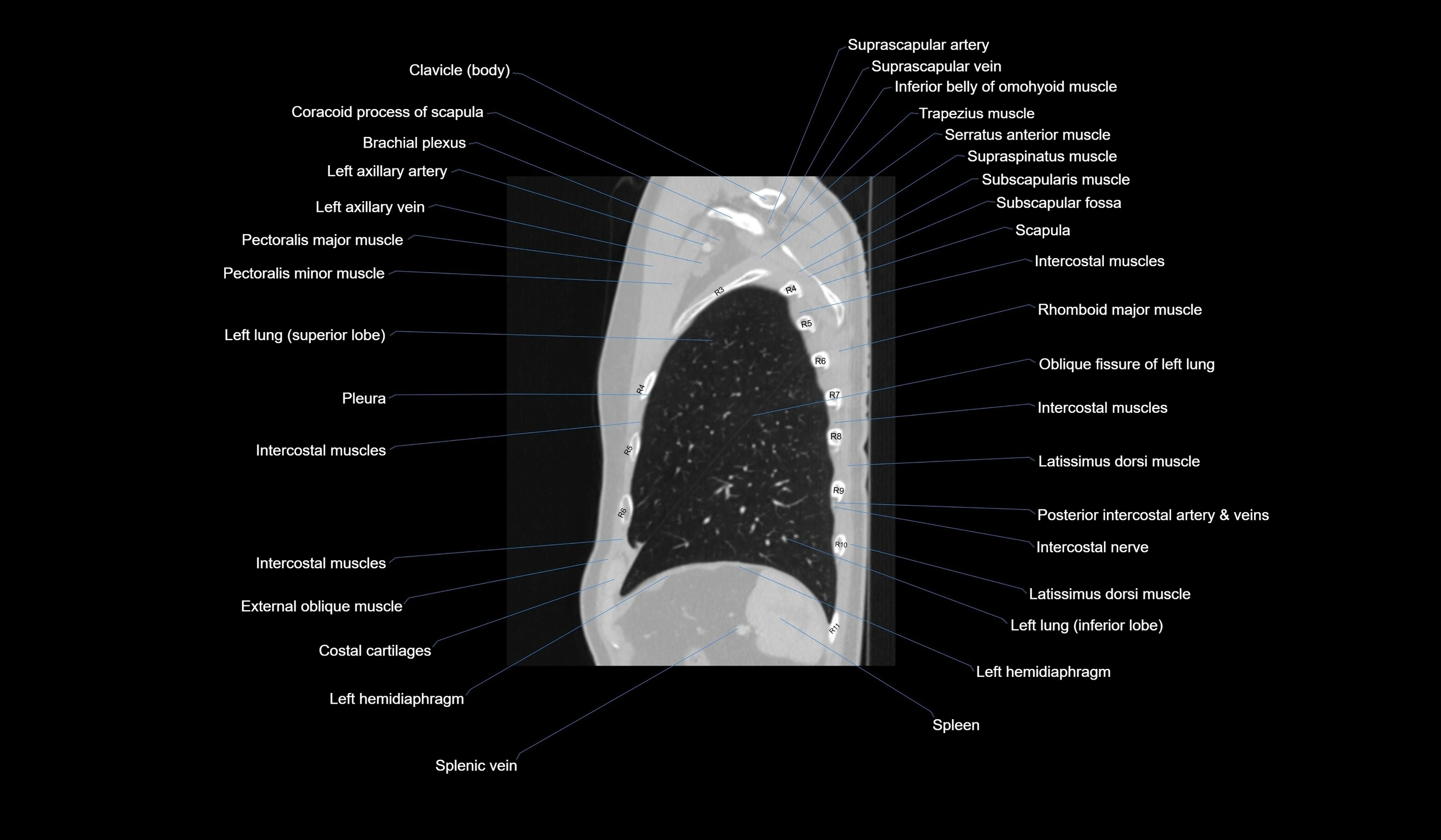 CT chest (thorax) labelled sagittal cross sectional anatomy radiology image-00118.webp